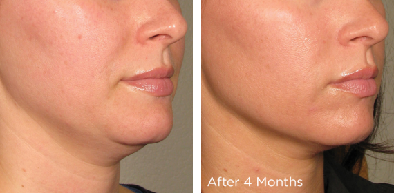 ULTHERAPY - Get non surgical skin lifting treatment