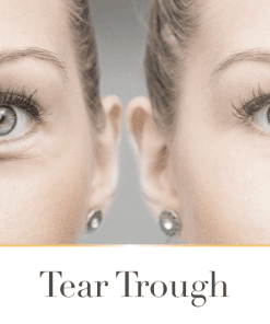 Dermal Fillers (Tear Trough) TEOSYAL PURESENSE REDENSITY 2