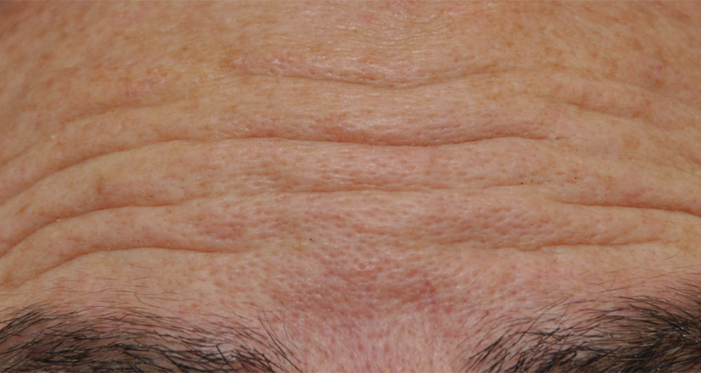 Forehead Wrinkles Ai Beauty Clinic