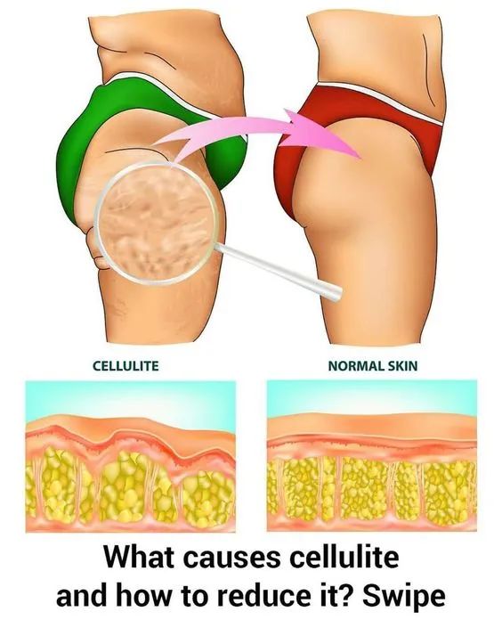 The 6 Science-backed Tips To Naturally Reduce Cellulite PDFs thumbnail