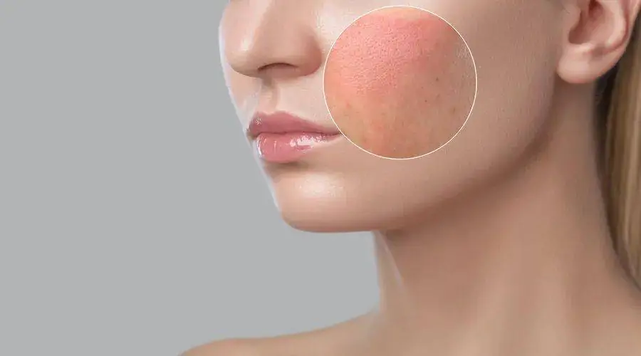 Sensitive Skin / Impaired Skin Barrier - Ai Beauty Clinic