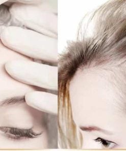 PRP Hair Loss