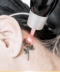 PicoSure Tattoo Removal