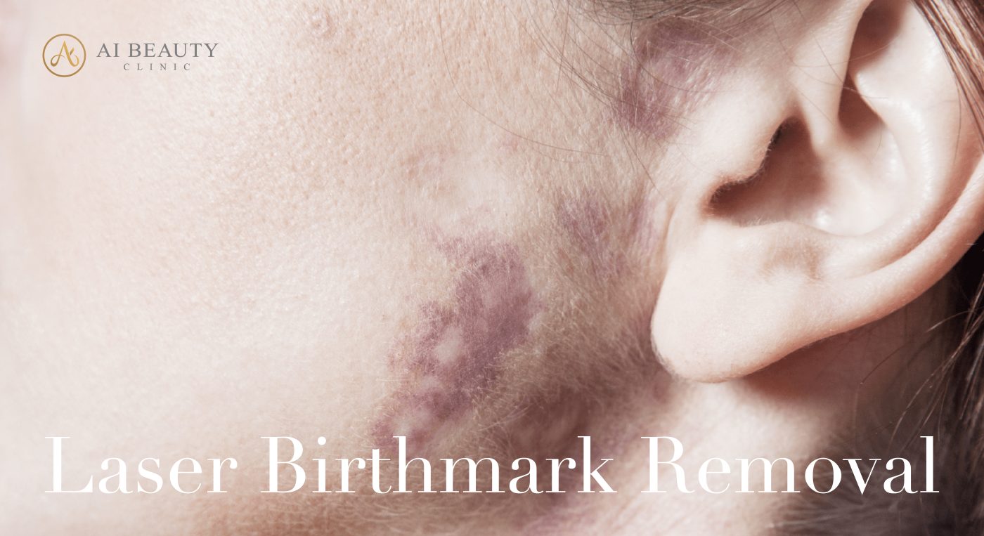 Laser birthmark removal