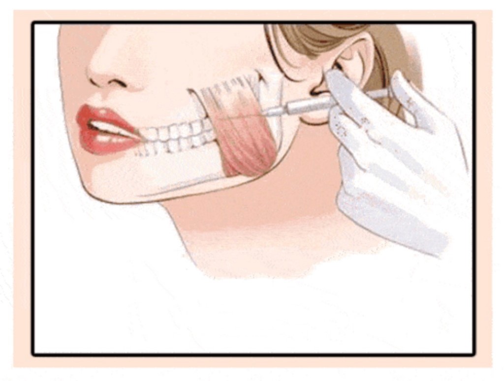 2. Injecting the Masseter