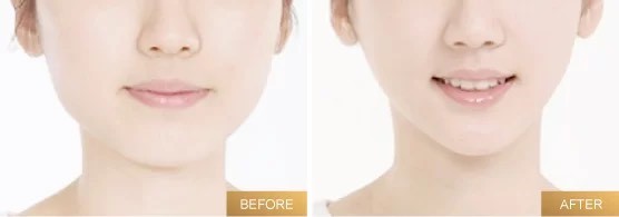 masseter botox before and after