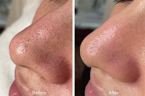 hydra b and a nose